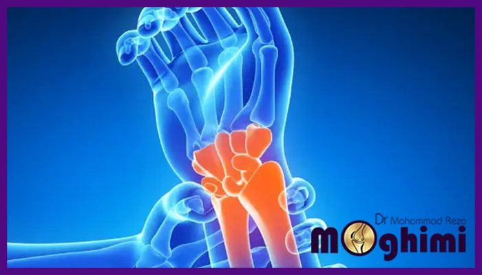 چرا جراحی تعویض مفصل مچ دست نیاز است؟