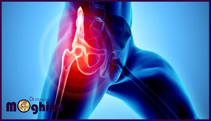 التهاب مفصل لگن