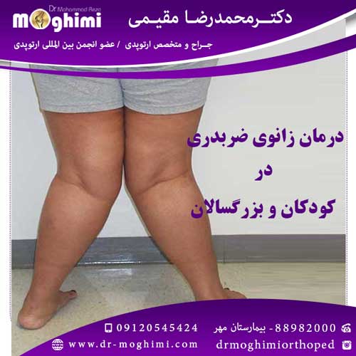 درمان زانوی ضربدری در کودکان - دکتر محمدرضا مقیمی