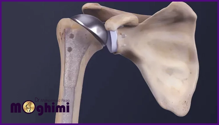 چه زمانی نیاز به انجام جراحی تعویض مفصل شانه است؟