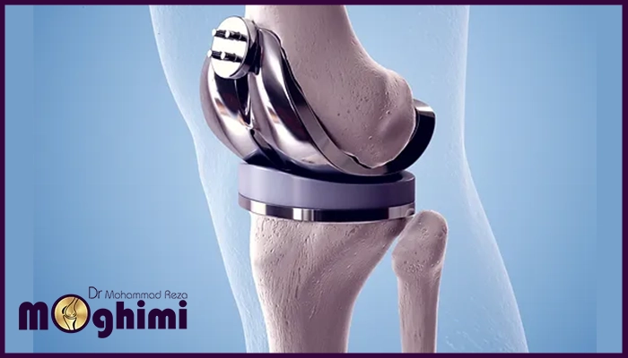 عوامل موثر بر هزینه تعویض مفصل زانو