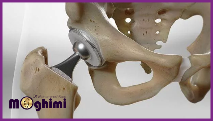 چه زمانی جراحی تعویض مفصل لگن مورد نیاز است؟