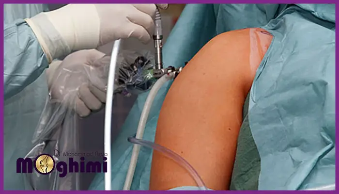 جراحی آرتروسکوپی شانه + مراحل