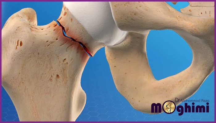 عوارضی که شکستگی لگن به همراه دارد؟