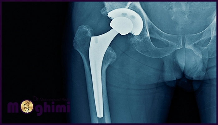 چه زمانی جراحی تعویض مفصل لگن باید انجام شود؟